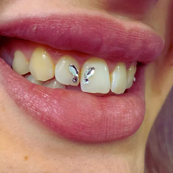 BRISHO Odontología integral – Joyería dental – Tratamiento de bruxismo y disfuncion articular