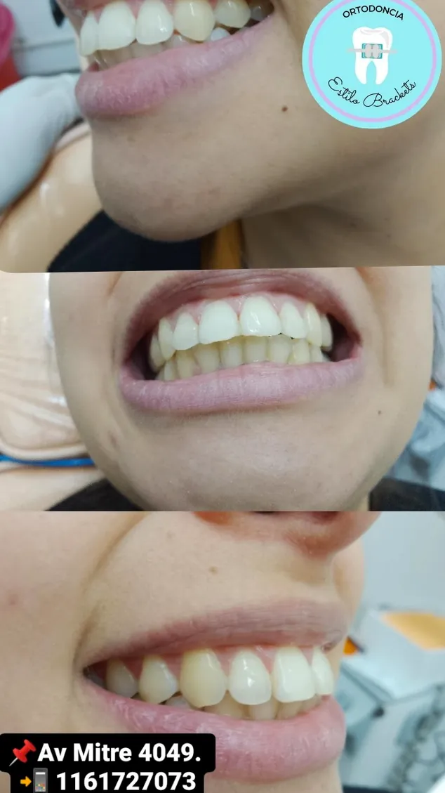 Estilo Brackets Ortodoncia